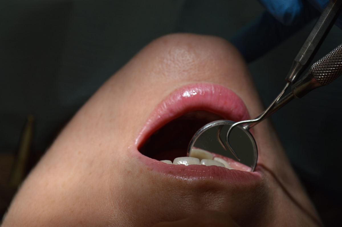 Pose d'un appareil orthodontique