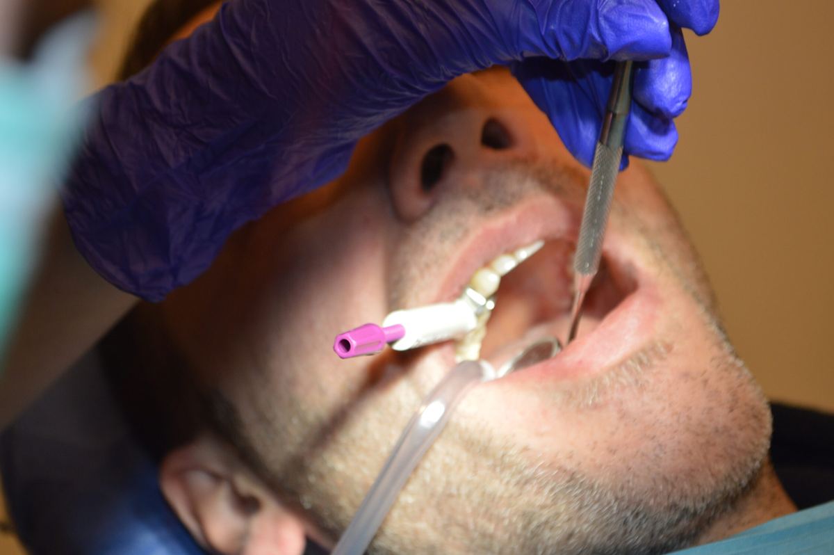 Traitement endodontique &agrave; la clinique