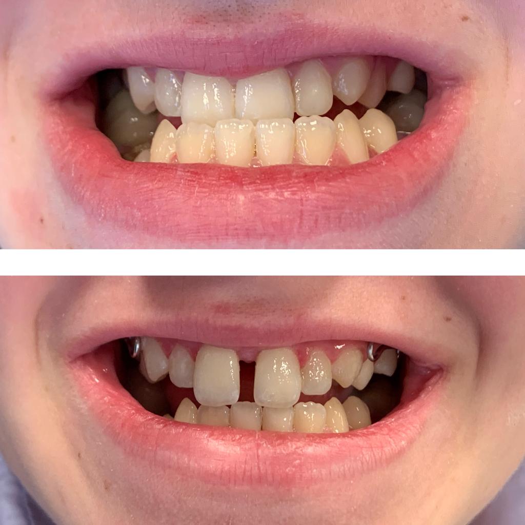 Traitement orthodontique en cours