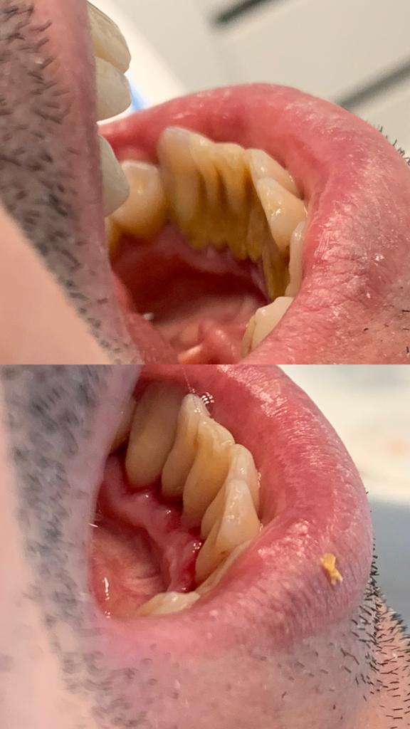 R&eacute;sultat apr&egrave;s hygi&egrave;ne orale