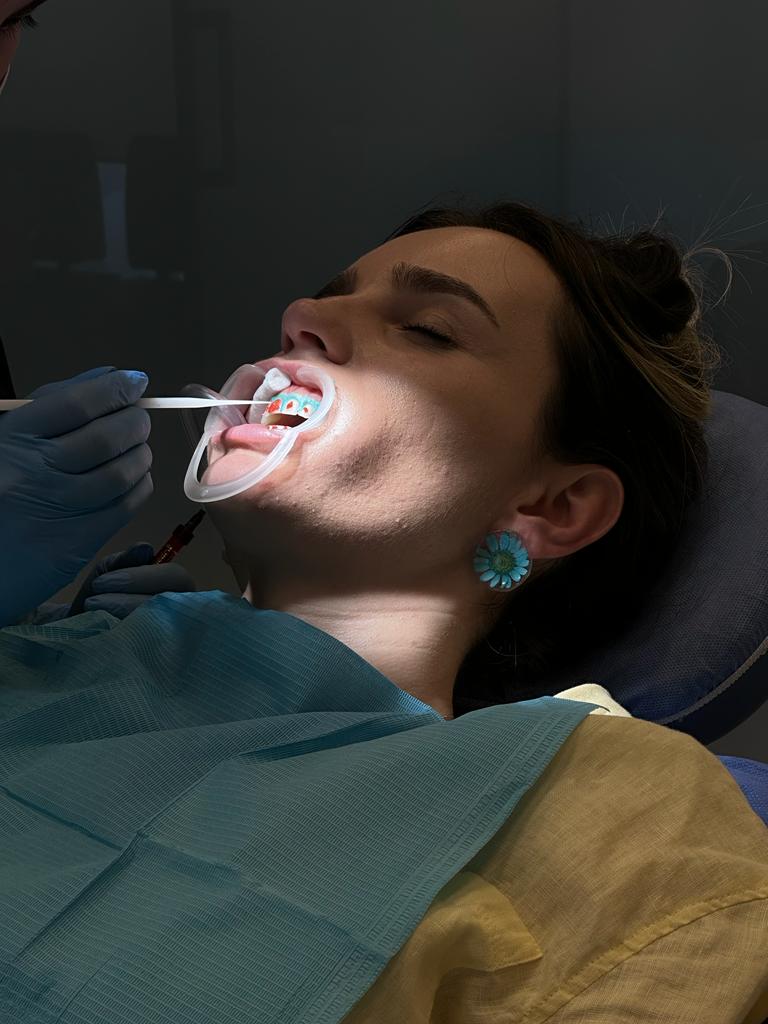 Cas d'esth&eacute;tique dentaire trait&eacute; &agrave; la clinique
