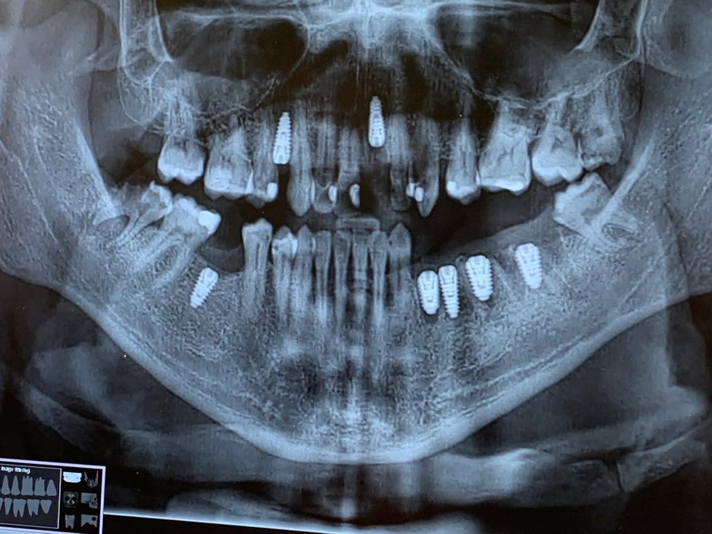 Proth&egrave;se sur implants